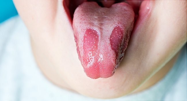Lưỡi bị thâm đen là bệnh gì? Những điều bạn cần biết! | Wall E