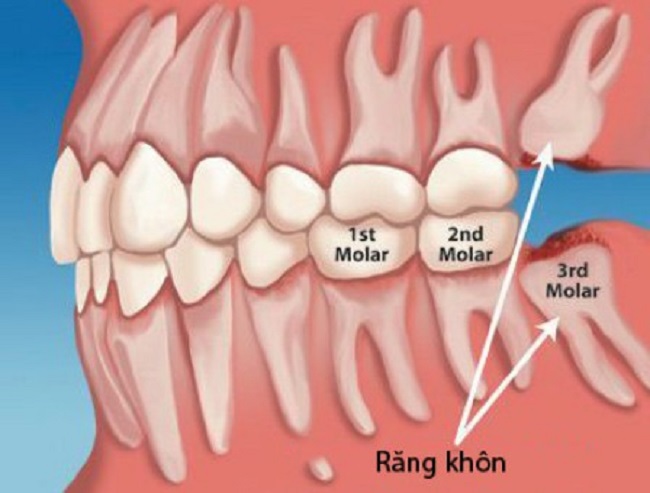 Răng số 8 là răng nào?