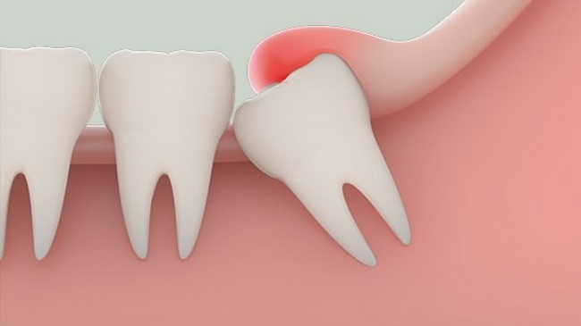 Biểu hiện của mọc răng khôn là gì?
